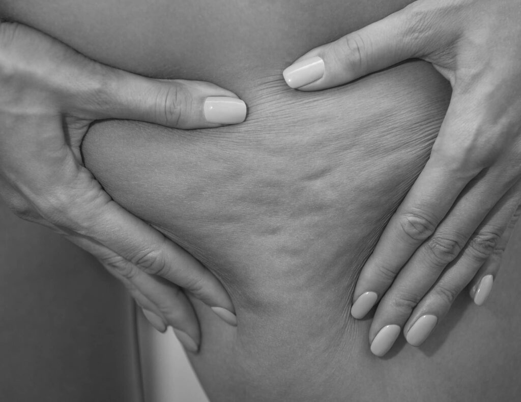 Traiter la cellulite, à Suresnes - Body Contouring - Tarif | CLEM, Centre Esthétique