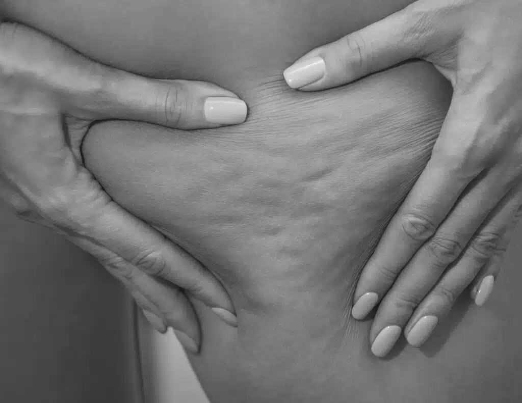 Traiter la cellulite, à Suresnes - Body Contouring - Tarif | CLEM, Centre Esthétique