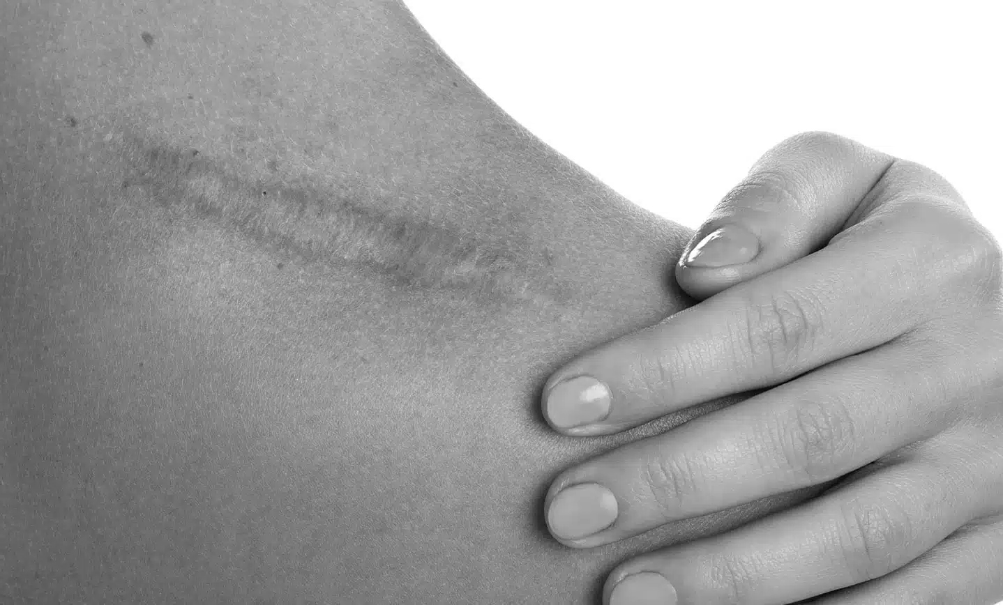 Traitement Cicatrices
