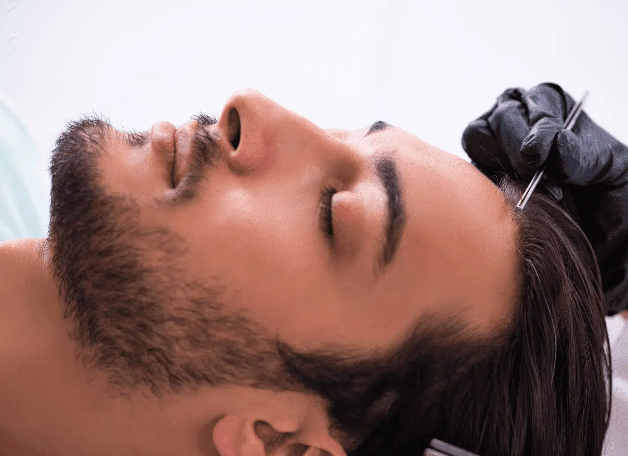 greffe-cheveux-fue-centre-clem-suresnes