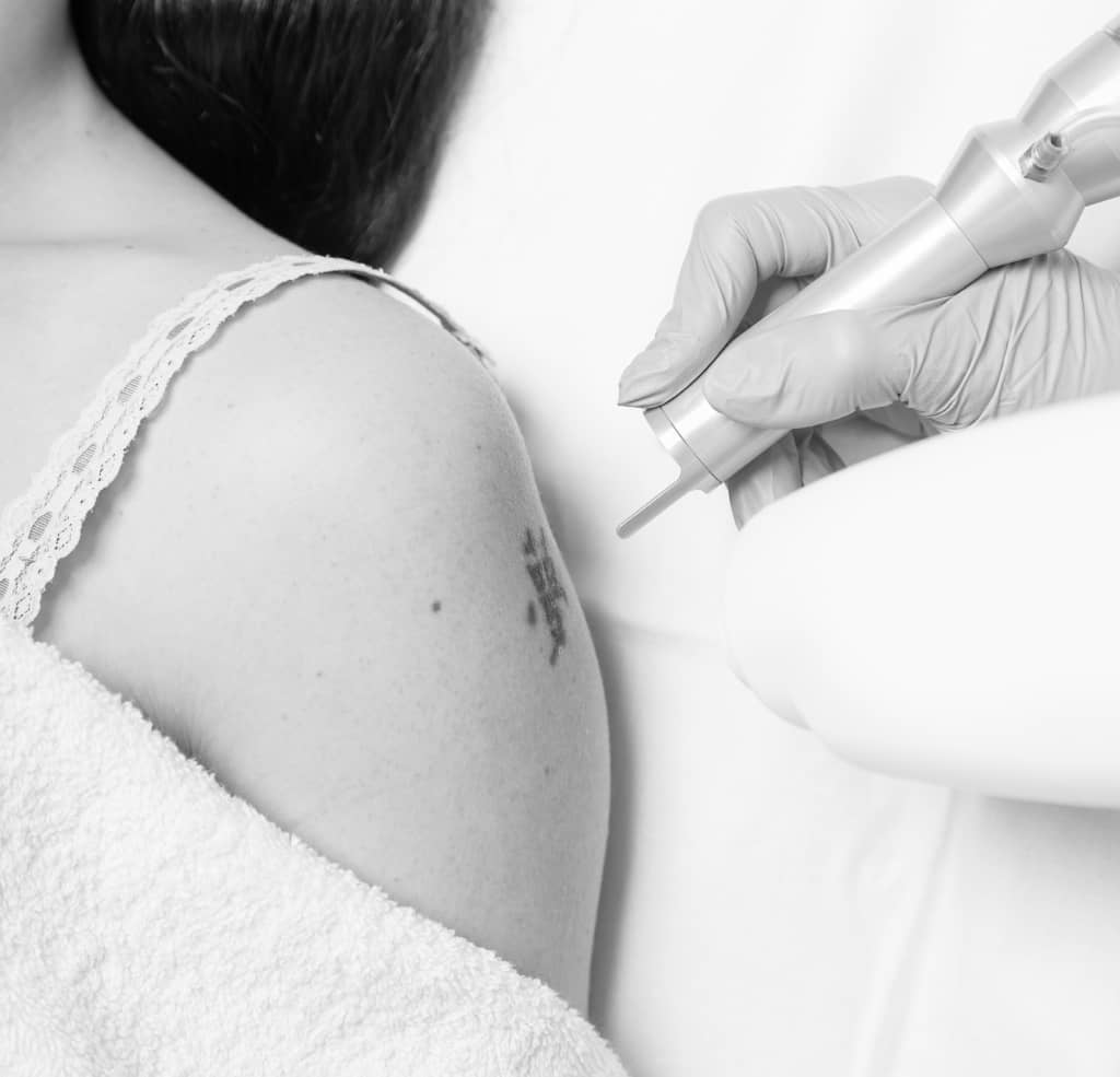 Mon tatouage est raté : comment faire ? | CLEM | Suresnes
