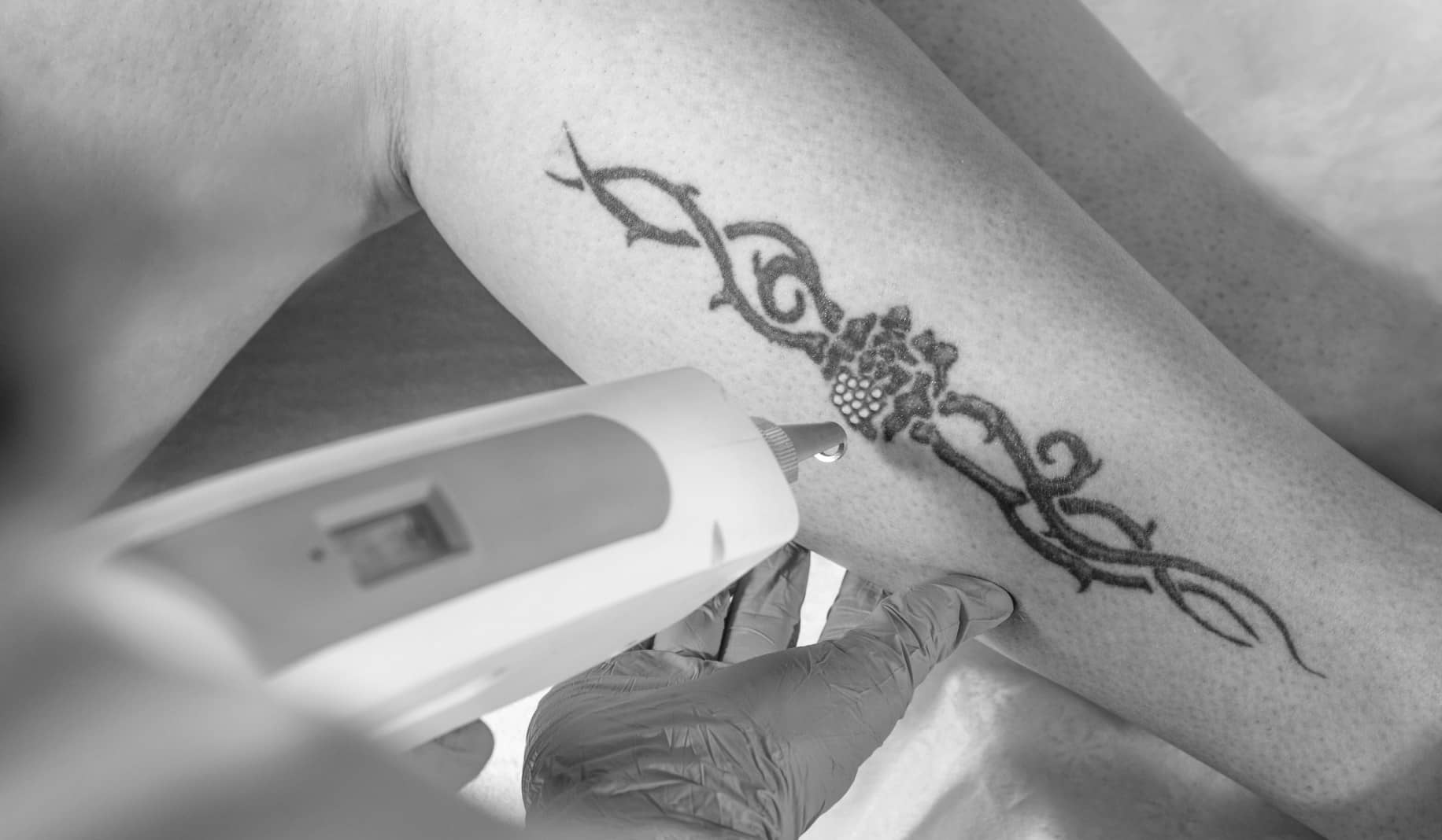 Suppression de tatouage : est-ce possible ? | CLEM | Suresnes