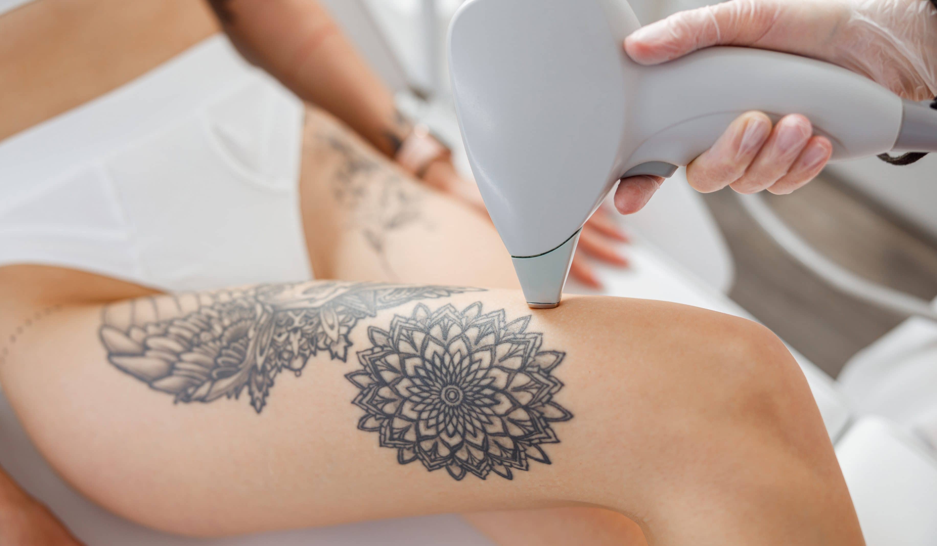Combien faut-il de séances de laser pour supprimer un tatouage ? | CLEM | Suresnes