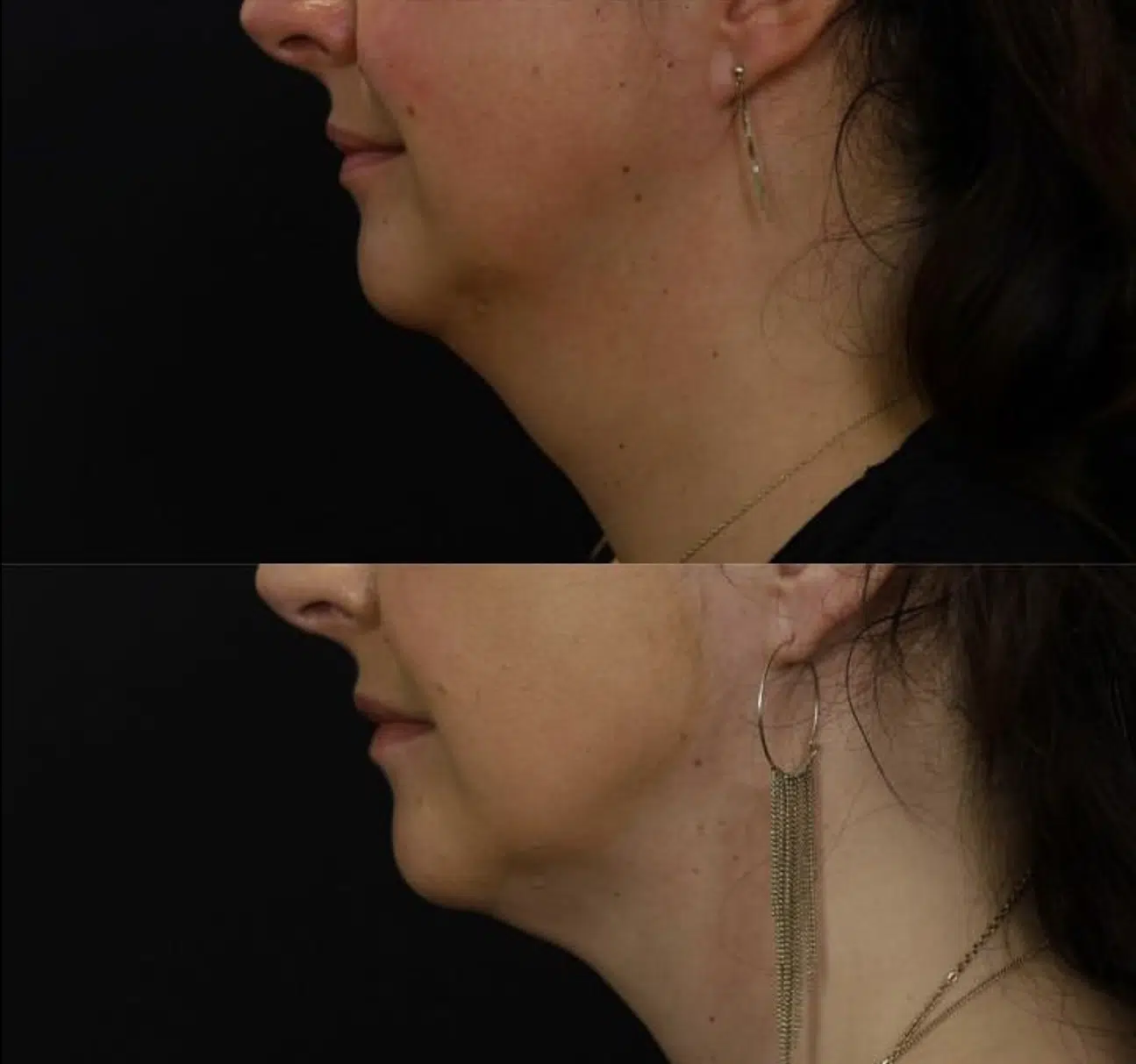 Acide hyaluronique avant/après ovale du visage