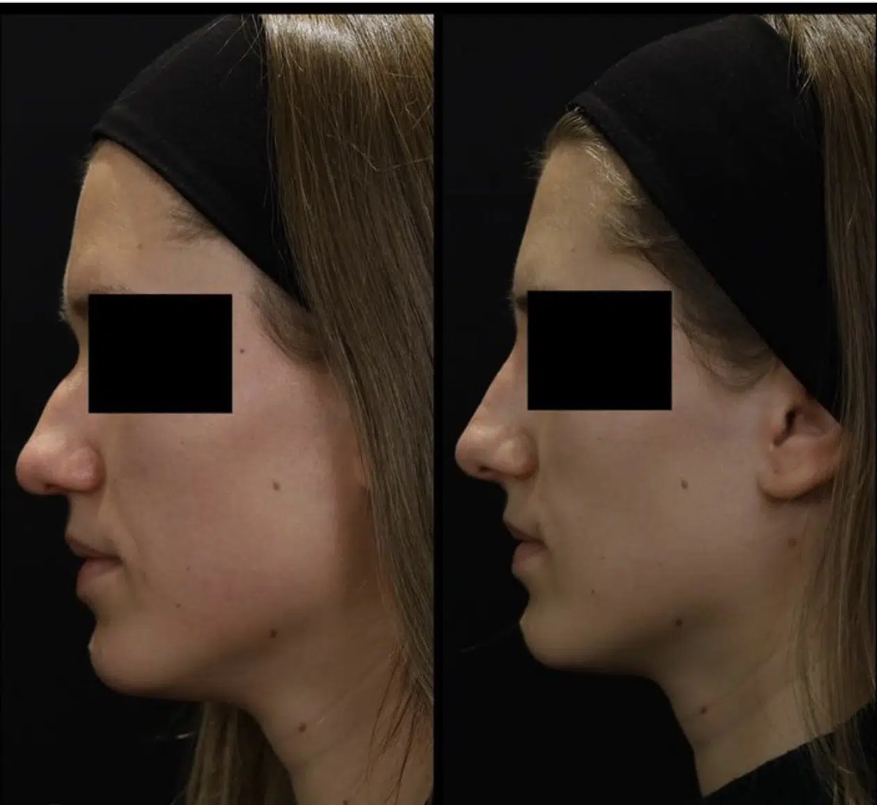 avant après rhinoplastie médicale