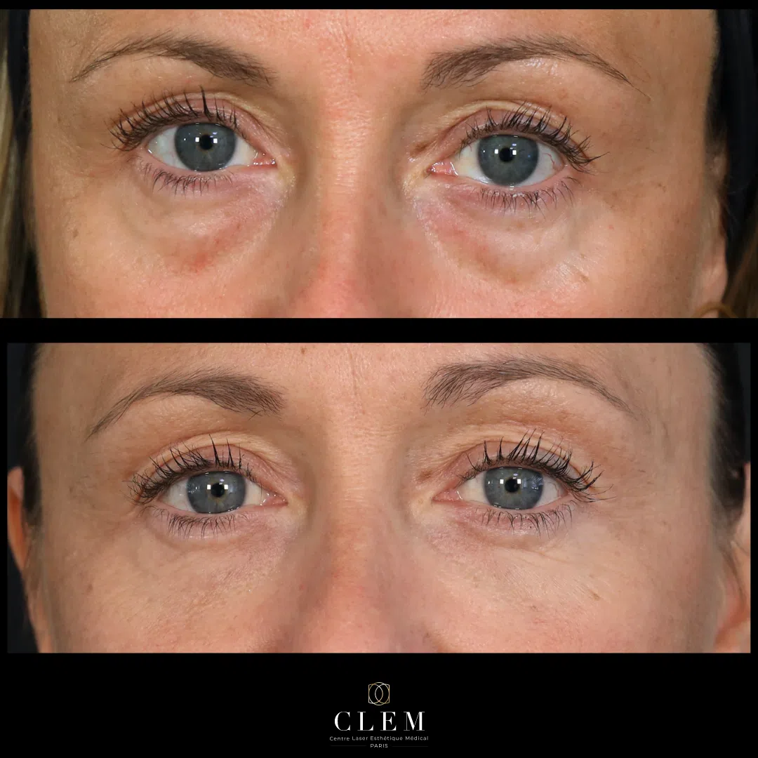 Traitement des cernes | CLEM