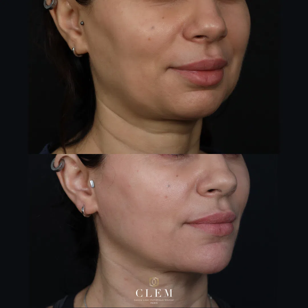 Injection d'acide hyaluronique ovale du visage