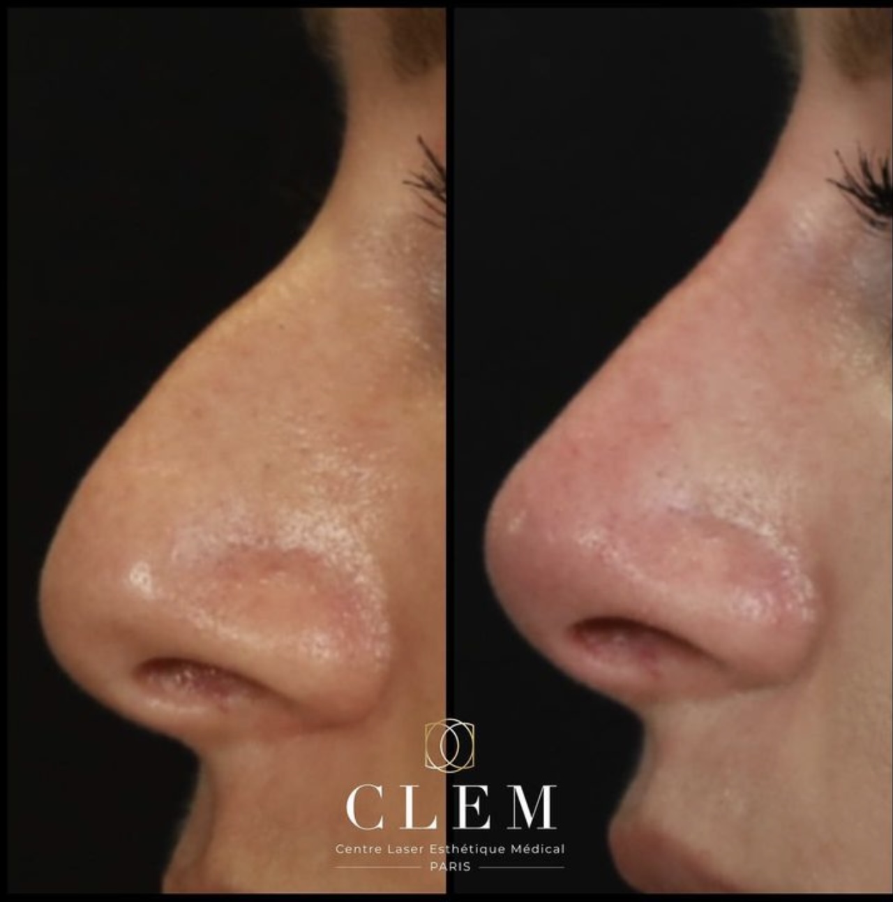 rhinoplastie médicale | CLEM