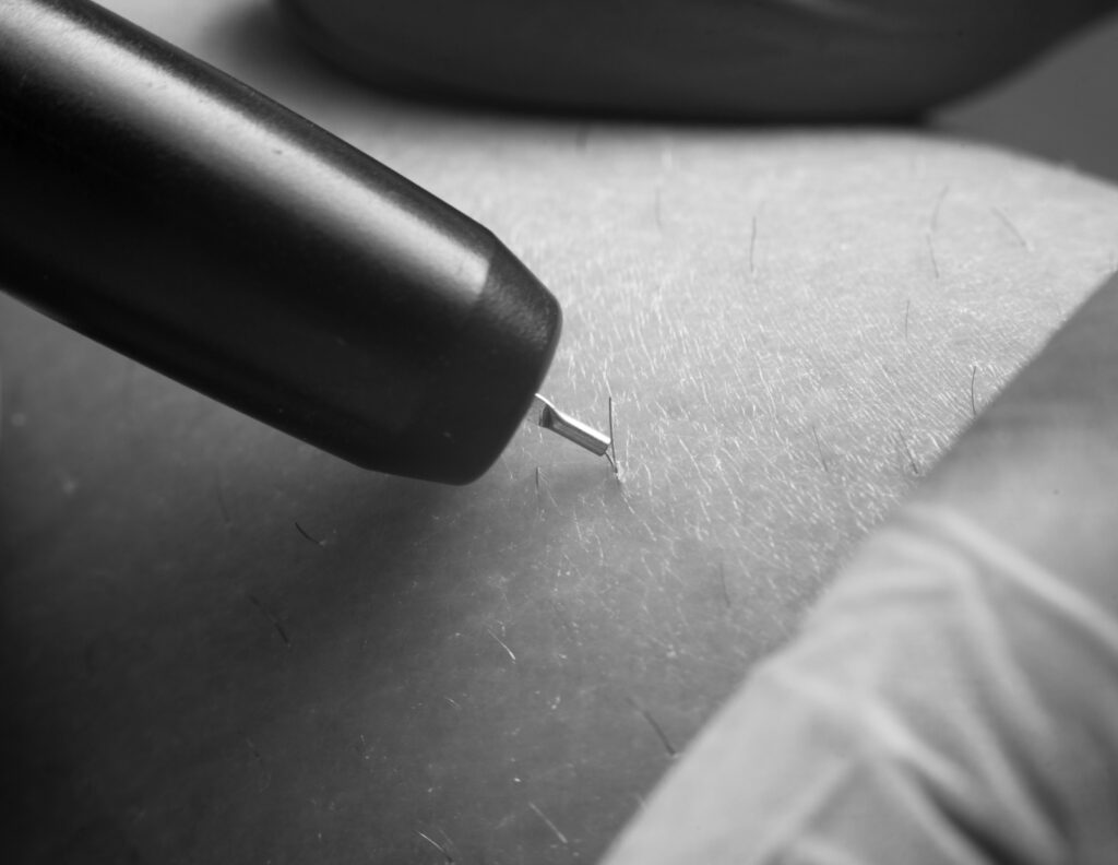 Epilation à haute fréquence Suresnes | CLEM